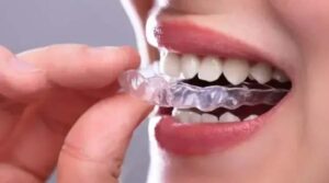 Read more about the article Clear Aligners Bali: A Complete Guide for First-Timers