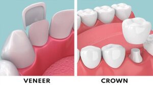 Read more about the article Key Differences and How to Choose Veneers vs Crowns Bali