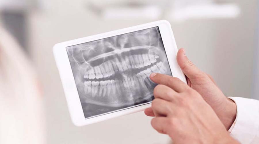 You are currently viewing Wisdom Tooth Removal Bali: What to Expect Before and After