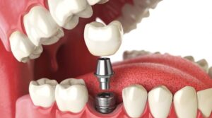 Read more about the article Dental Implants Bali: A Complete Guide for International Patients