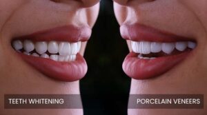 Read more about the article Teeth Whitening vs Veneers: Which Fits Your Smile Goals?