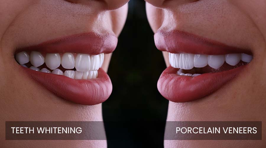You are currently viewing Teeth Whitening vs Veneers: Which Fits Your Smile Goals?