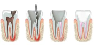 Read more about the article Root Canal Treatment Bali: How to Stop Tooth Pain and Save Your Tooth