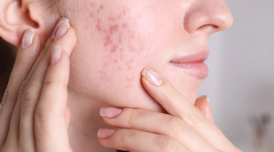 You are currently viewing Acne Treatment Bali: Clearer Skin in a Humid Climate