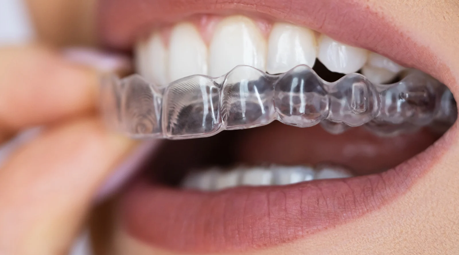 You are currently viewing Clear Aligner Bali: Straighter Teeth Without Braces