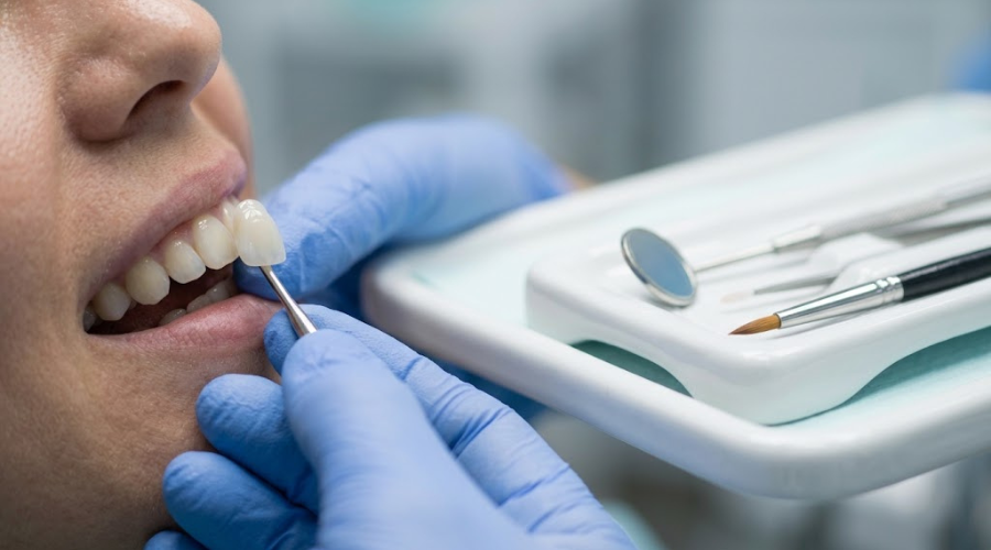 You are currently viewing Porcelain Veneers Bali: Cost, Process, and What to Expect